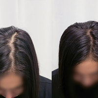 두피 커버 체험단 모집